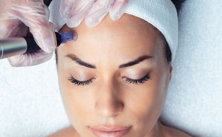 Microneedling Sevierville Anti Aging Absolute Beauty